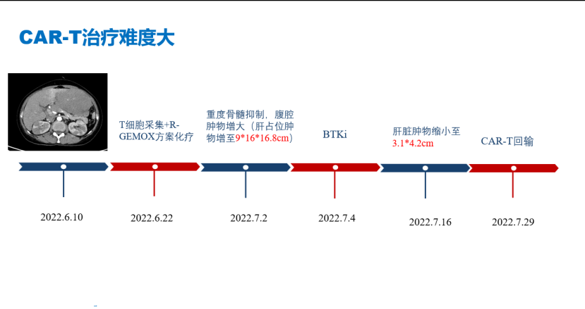 層流床應用實踐：重慶大學附屬腫瘤醫(yī)院血液腫瘤中心完成又一例高難度淋巴瘤患者CAR-T細胞治療